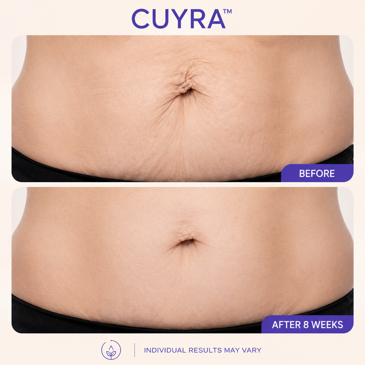 Cuyra™ Tighten & Smooth Belly Cream
