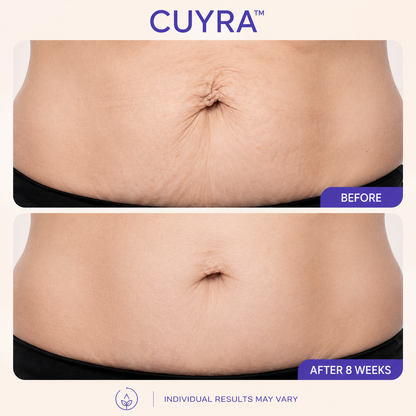 Cuyra™ Tighten & Smooth Belly Cream